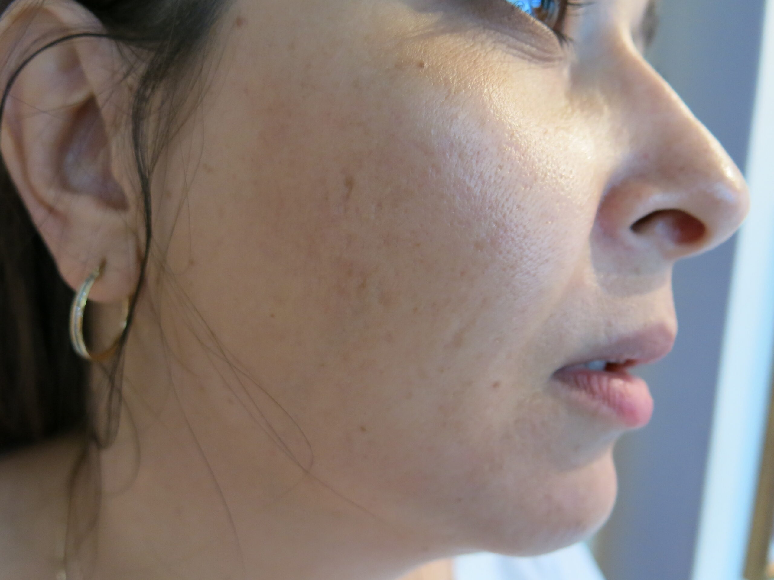 Acne Scarring Treatment_HE_after