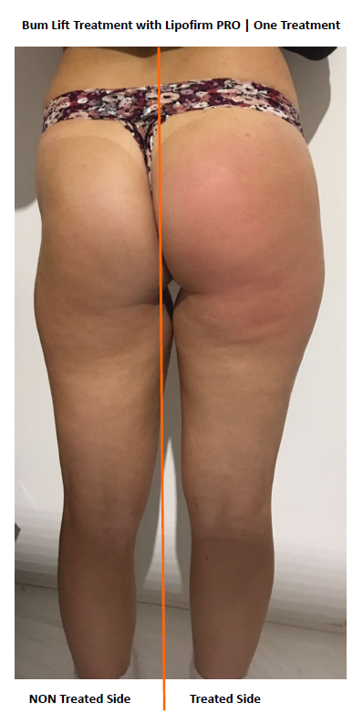Bumlift_one treatment_one side treatment to show result