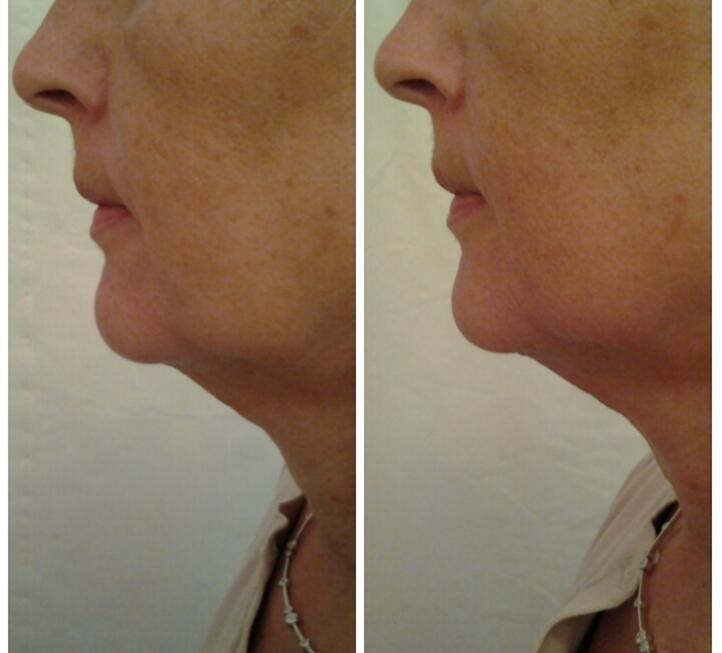 Chin after one treatment - compliments of Woman to Woman