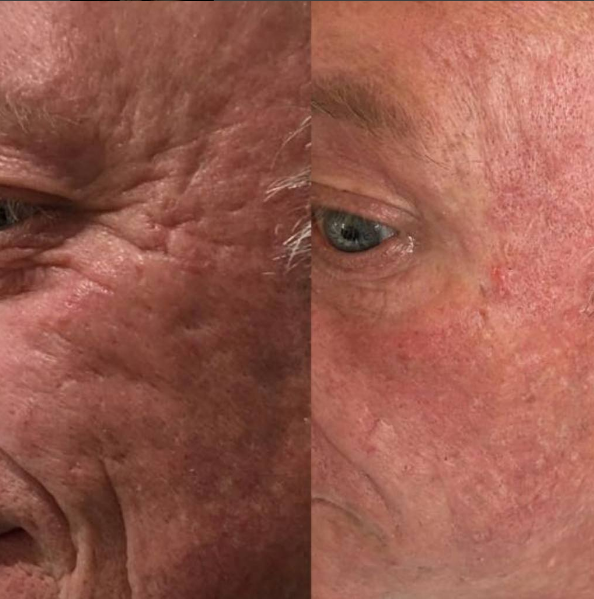 trifractional and RF before and after two sessions